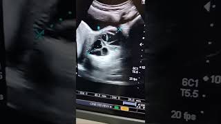 multiple septated adnexal cysts ovarian cystspelvis ultrasound gynaelogical ultrasound [upl. by Hardman107]