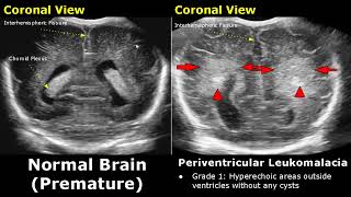 Neonatal Brain Ultrasound Normal Vs Abnormal Images  Full Term Infant amp Premature Newborn Head USG [upl. by Olson]