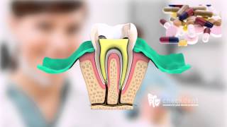 What is a Root Canal Treatment [upl. by Ahtrim]