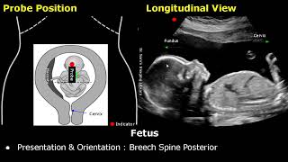 Obstetric Ultrasound Probe Positioning  Pregnant Uterus amp Fetus Transducer Placement USG Scan [upl. by Yeliw]