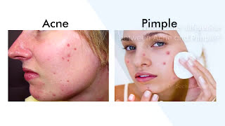 Difference Between Acne And Pimple Best Skin Care Clinic In Bangalore  Manipal Hospitals [upl. by Allmon]