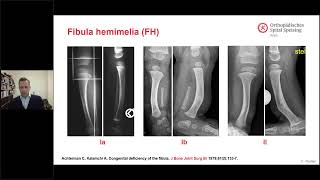 EPOS Study Group Webinar Congenital Femoral Deficiency and Fibular Hemimelia 1 [upl. by Leirud]