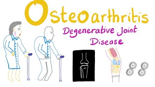 Osteoarthritis OA  Introduction  Rheumatology Series [upl. by Particia258]