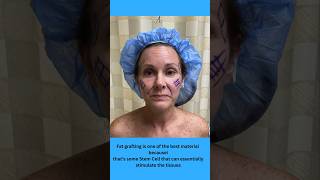 Fat Transfer Into Face  Natural New Face  Face Lift [upl. by Jesus]