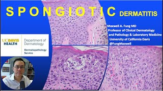 DERMATOPATHOLOGY Spongiotic Dermatitis [upl. by Knorring]