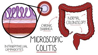 Microscopic Colitis Lymphocytic amp Collagenous Colitis  An Underdiagnosed Form of IBD [upl. by Hanforrd]