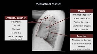 How to Interpret a Chest XRay Lesson 5  Cardiac Silhouette and Mediastinum [upl. by Ranson304]