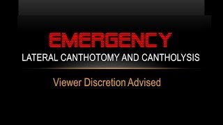 Emergency Lateral Canthotomy and Cantholysis [upl. by Junette]