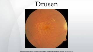 Drusen [upl. by Athal]