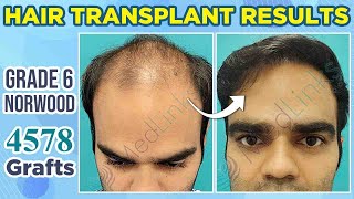 💥Best Hair Transplant in India  Hair Transplant Results After 9 Months  Patient Review [upl. by Kayla]