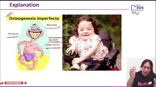 NEET MDS 2024 Oral Pathology  Osteogenesis imperfecta [upl. by Ennobe]