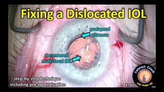 fixing a dislocated IOL tecnis multifocal IOL [upl. by Farl403]