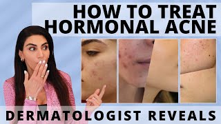 Dermatologist Unveils How to Treat Hormonal Acne  acne acnetreatment hormonalacne [upl. by Sirref]