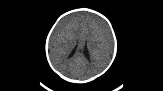 Efusão subdural frontoparietal bilateral pós meningite [upl. by Zeni]