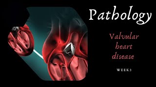 valvular heart disease  pathology week 3 [upl. by Noir181]