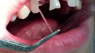 Tooth Nerve Removal [upl. by Inail]