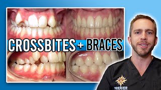 Crossbite Braces Treatment BEFORE amp AFTER [upl. by Noillid880]