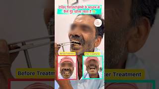 Mouth Opening Exercises for Cancer Patients  Cancer Trismus care shorts mouthcancertreatment [upl. by Nutsud]