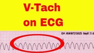 Ventricular Tachycardia on ECG [upl. by Akinna]