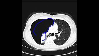 Pneumothorax due to lymphangioleiomyomatosis [upl. by Atauqal]