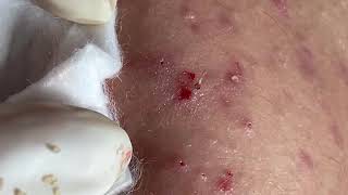 Wow Lot’s of Acne P2  Acne Treatment Mai Ngoc Da Nang [upl. by Par]