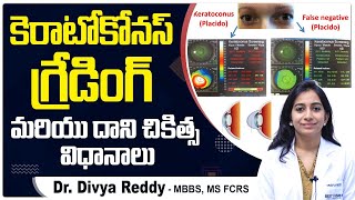 కెరాటోకోనస్ గ్రేడింగ్  Keratoconus Grading and Its Treatment Options  Best Vision Eye Hospital [upl. by Uhej]