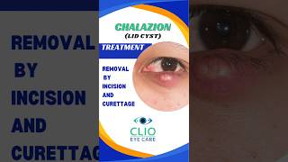 Chalazion Treatment Incision and Curettage  CLIO Eye Care [upl. by Longtin]