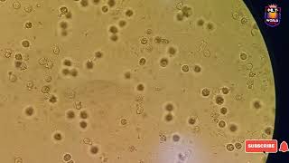 Pus cells in urine microscopy [upl. by Yarased]