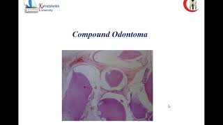 cementoblastoma and mixed odontogenic [upl. by Powell199]