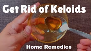 How to Get Rid of Keloids  Natural Home Remedies to Remove Keloids [upl. by Gnuy]