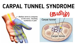 Carpal Tunnel Syndrome  Causes  Symptoms  Investigation  Treatment  தமிழ் [upl. by Norrv]