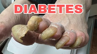 VERY THICK AND LONG DIABETIC TOE NAILS [upl. by Yahsan365]