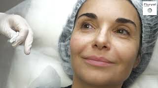 Attractive face with Pluryal Creating natural volume and increasing skin density [upl. by Golda]