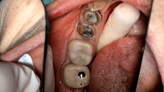 Two Premolar Crown Preps no narration [upl. by Tigirb64]