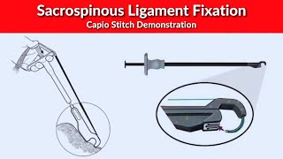 Sacrospinous Ligament Fixation  Capio Stitch Demonstration  Dr Kunal Rathod [upl. by Oremo]