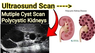 Ultraosund Scan  Multiple Cyst 👉🏻Polycystic kidneys Scan [upl. by Mommy]