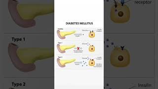 Metabolic disorder Diabetes Mellitus Type1 and Type2 [upl. by Sualocin16]