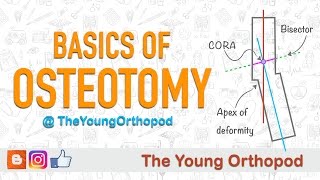 Basics of Osteotomy [upl. by As]