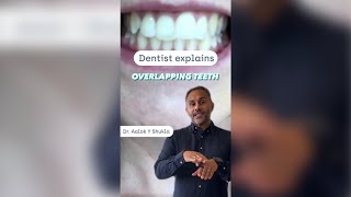 How to straighten overlapping teeth 🦷 shorts [upl. by Serica]