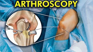 The World of Arthroscopic Surgery How Arthroscopy is performed Include 3d animation [upl. by Ylil975]