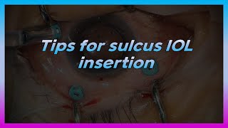 Tips for sulcus IOL insertion [upl. by Atikan193]