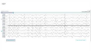 EEG Atlas B3 Understand EEG Through Examples With The Ceribell Rapid Response System [upl. by Nilek]