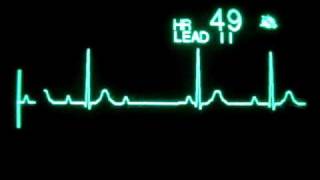 2nd Degree Atrioventricular Block Type I Mobitz I Wenckebach [upl. by Jocelyne]