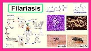 filariasis [upl. by Natie681]