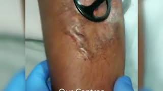 keloid and hypertrophic scars laser treatment [upl. by Amol]