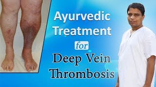 Ayurvedic Treatment for Deep Vein Thrombosis  Acharya Balkrishna [upl. by Avictor]