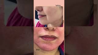 Eliminate Marionette Lines and Smile Lines with Full Face Filler Injection by Dr Sanaz Amiri [upl. by Goeselt]