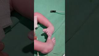 Newborn with Clubfoot  Congenital Deformity  Orthopediatric newborn congenital boneproblems [upl. by Kalam]