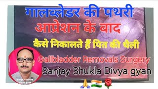 Gallbladder Stones Removed Surgery trending motivation Dr VP Singh Faijabad Ayodhya UP [upl. by Eenhat]