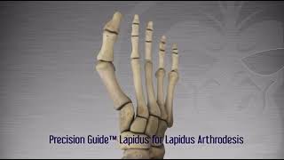 Lapidus Arthrodesis using Gorilla Recon Lapidus Plating System from Paragon28 [upl. by Rika637]